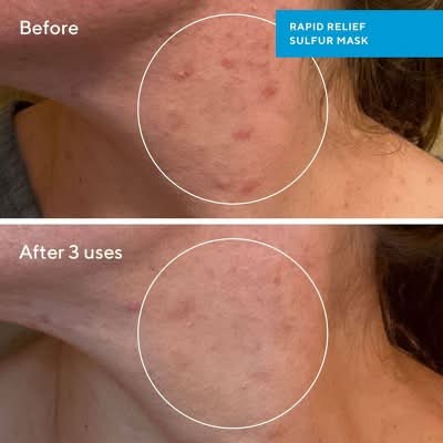 Murad Rapid Relief Acne Sulfur Facial Mask (2.5 fl oz)